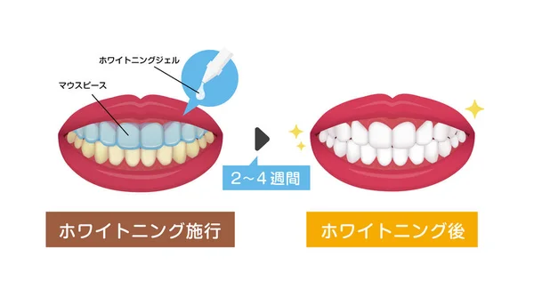 Λεύκανση Δοντιών Διανυσματική Απεικόνιση Πριν Και Μετά Ιαπωνικά — Διανυσματικό Αρχείο