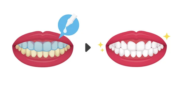 Clareamento Dos Dentes Ilustração Vetorial Antes Depois —  Vetores de Stock