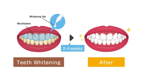 Clareamento Dos Dentes Ilustração Vetorial Antes Depois —  Vetores de Stock