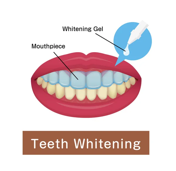 Dientes Blanqueamiento Casa Vector Ilustración — Archivo Imágenes Vectoriales