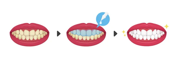 Dientes Blanqueamiento Vector Ilustración Antes Después Sin Texto — Archivo Imágenes Vectoriales