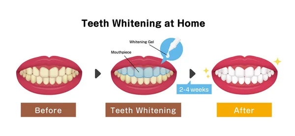 歯のホワイトニングベクターイラスト — ストックベクタ