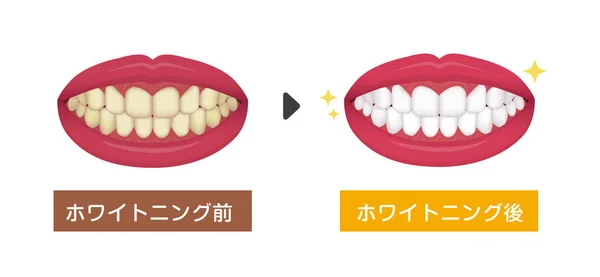 Teeth Whitening Vector Illustration Japanese — Stock Vector