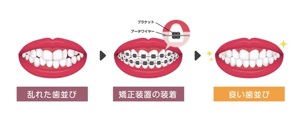 Dental Braces Processo Vetor Ilustração Japonês —  Vetores de Stock