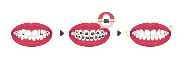Dental Braces Process Vector Illustration Text — Stock Vector