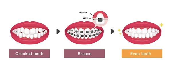 Dental Braces Processo Vetor Ilustração —  Vetores de Stock