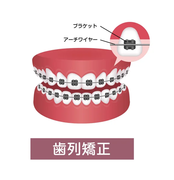 Dental Braces Vector Illustration Japanese — Stock Vector