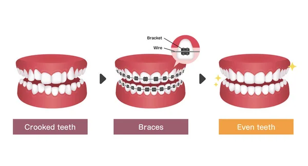 Dental Braces Processo Vetor Ilustração —  Vetores de Stock
