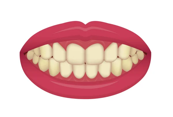 歯のホワイトニング ホームベクトルイラスト 黄色い歯 — ストックベクタ