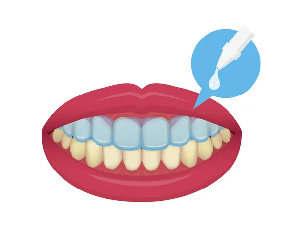 Teeth Whitening Home Vector Illustration Text — 스톡 벡터