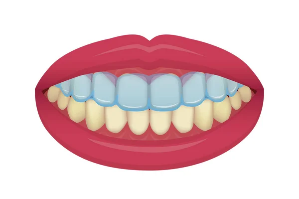 歯のホワイトニング ホームベクトルイラスト なしテキスト — ストックベクタ