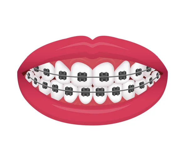 Braces Dentaires Illustration Vectorielle Pas Texte — Image vectorielle