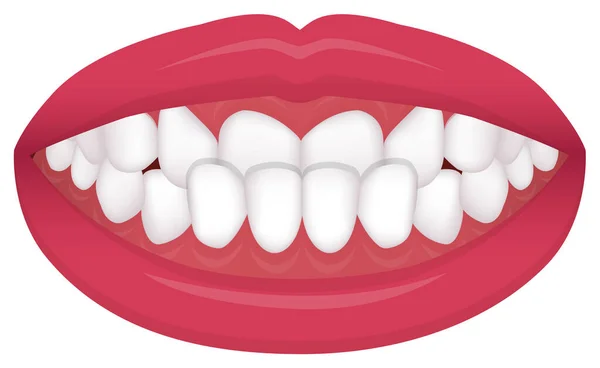 Teeth Trouble Bite Type Crooked Teeth Vector Illustration Underbite — Stock Vector