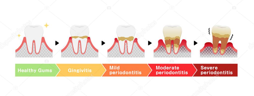 The stages of periodontitis disease vector illustration