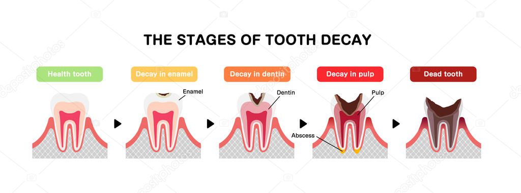 The stages of tooth decay / flat vector illustration