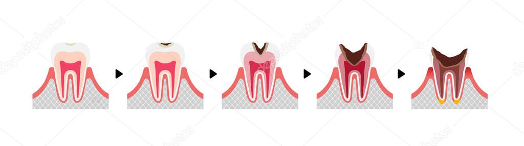 The stages of tooth decay / flat vector illustration (no text) 