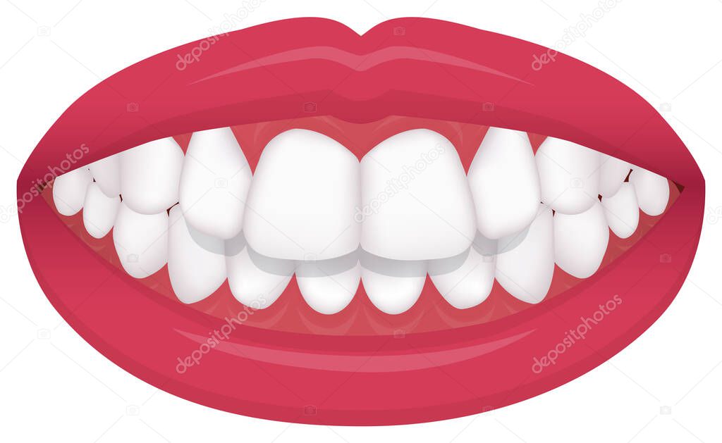 Teeth trouble ( bite type / crooked teeth ) vector illustration /Overbite (Back teeth)