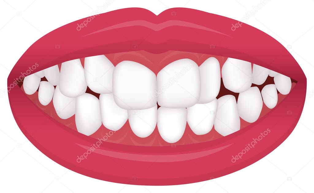 Teeth trouble ( bite type / crooked teeth ) vector illustration /Crowding