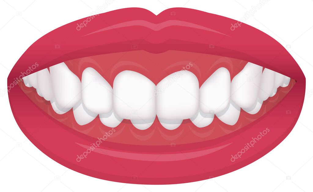 Teeth trouble ( bite type / crooked teeth ) vector illustration /Deep bite