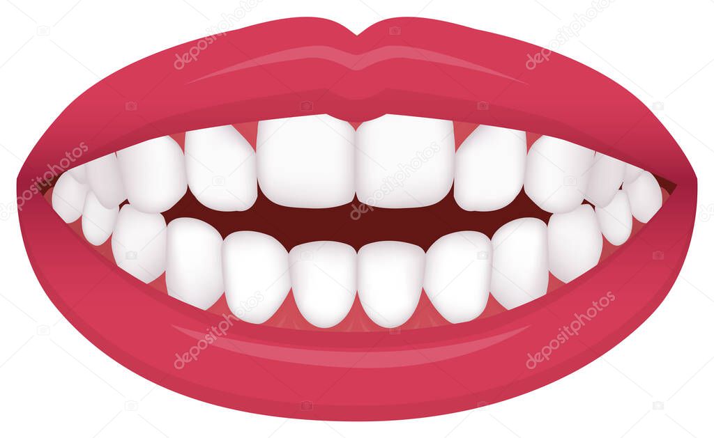 Teeth trouble ( bite type / crooked teeth ) vector illustration /Open bite