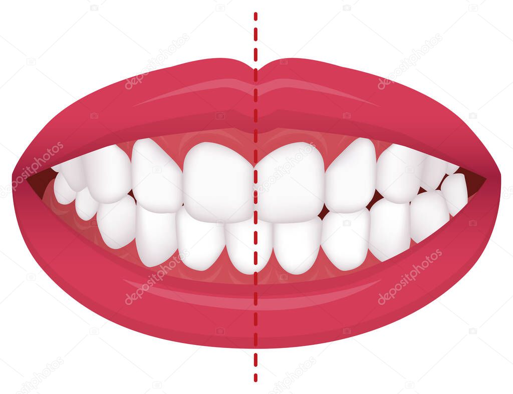 Teeth trouble ( bite type / crooked teeth ) vector illustration  /Crossbite (misalignment)