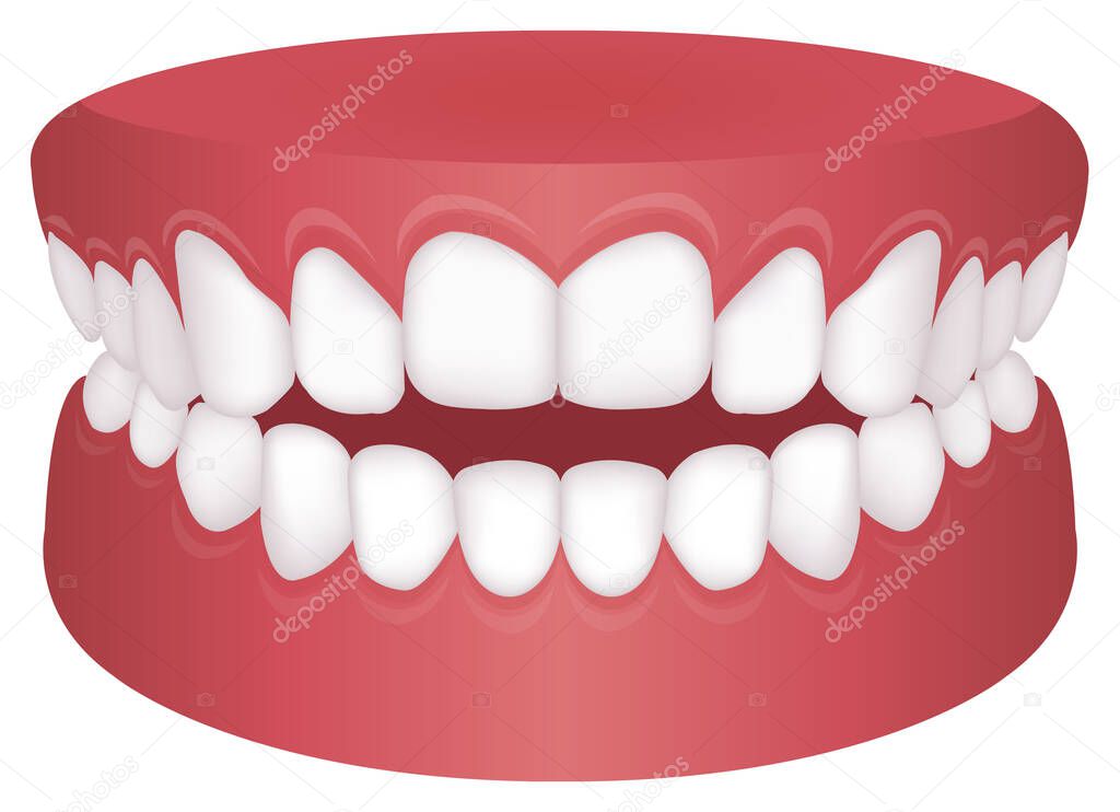 Teeth trouble ( bite type ) vector illustration /Open bite