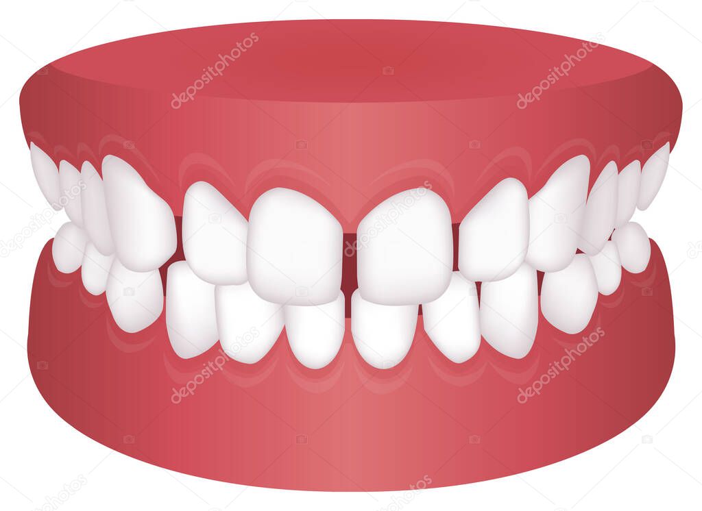 Teeth trouble ( bite type ) vector illustration / /Excessive Spacing