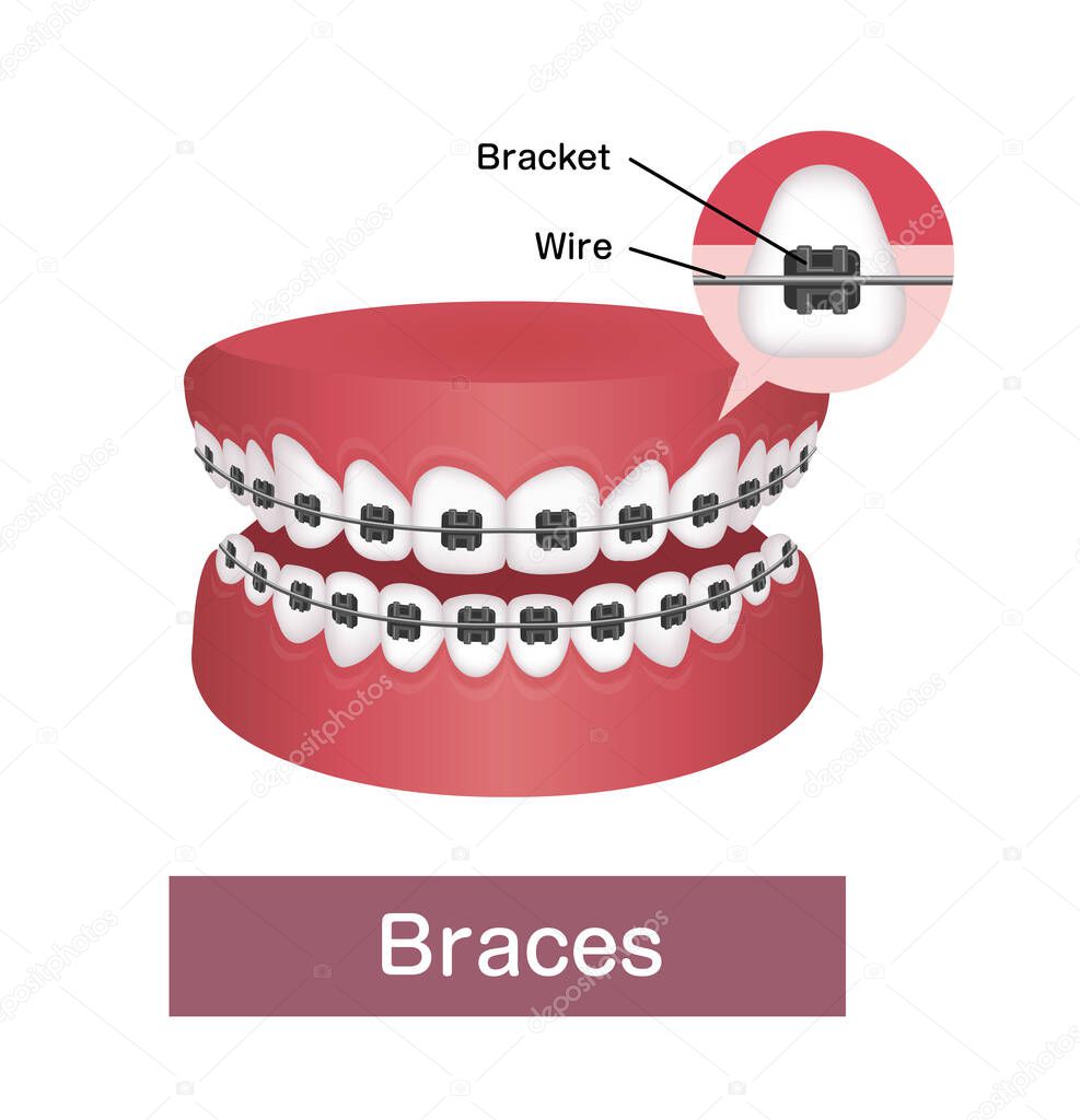 Dental braces flat vector illustration 