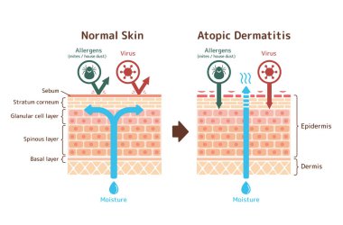 Atopik dermatit ve normal cilt / Karşılaştırmalı vektör illüstrasyonunun kısmi görünümü