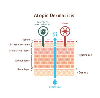 Atopik dermatit / vektör illüstrasyonunun bölümsel görünümü