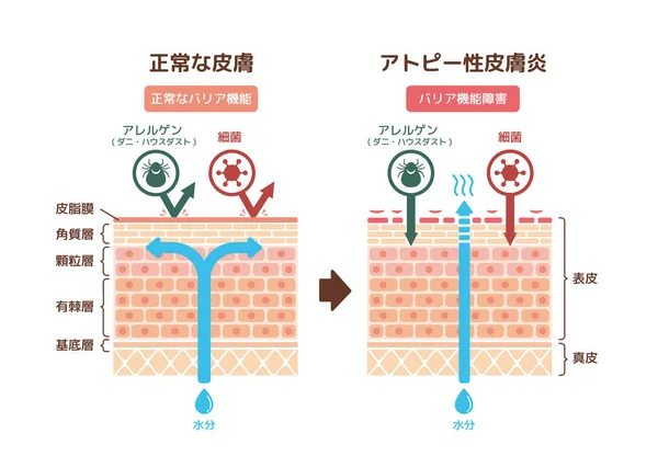 Vue Coupe Dermatite Atopique Peau Normale Illustration Vectorielle Comparative Japonais — Image vectorielle
