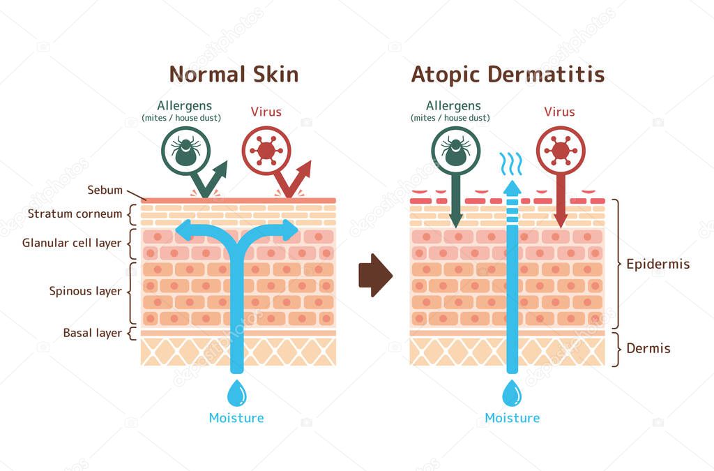 Sectional view of atopic dermatitis and normal skin / Comparative vector illustration