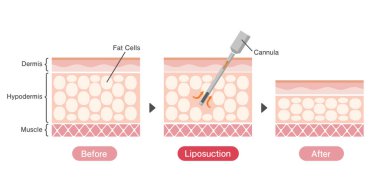 Liposuction süreci vektör illüstrasyonu / cildin bölümsel görünümü