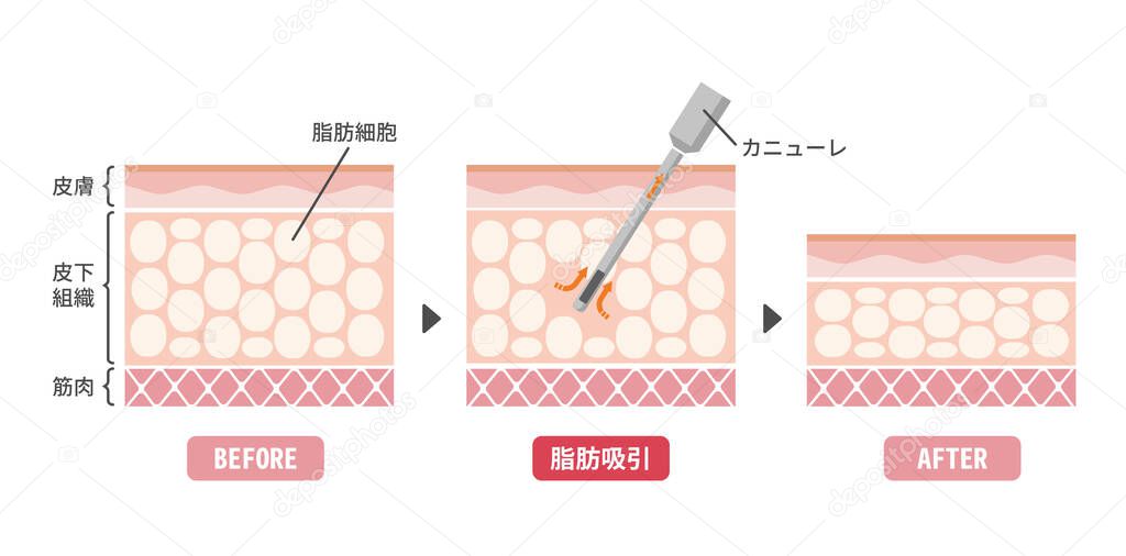 Liposuction process vector illustration / sectional view of skin