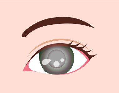 Göz hastalığı vektörü illüstrasyonu / Glaucoma