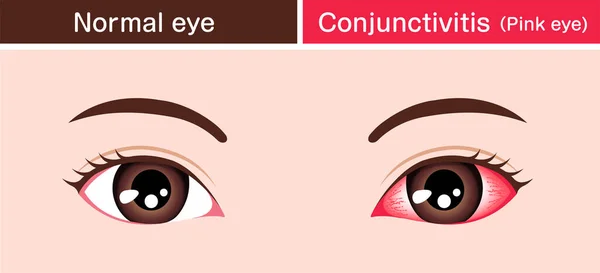Normales Auge Und Bindehautentzündung Rosa Auge Vektorillustration — Stockvektor