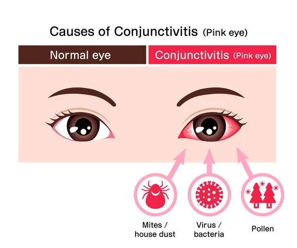 結膜炎 ピンクの目 の原因ベクトル図 — ストックベクタ