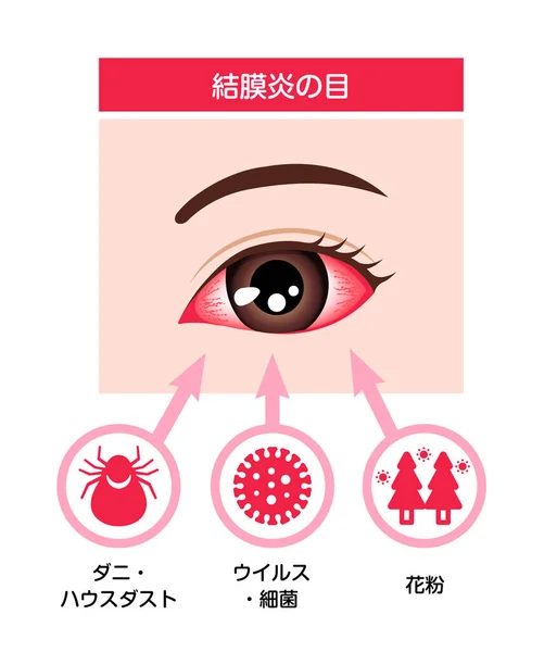 結膜炎 ピンクの目 の原因ベクトル図 — ストックベクタ