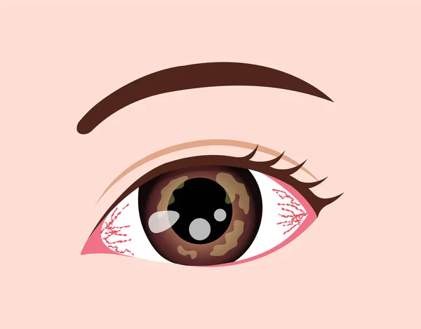 Eye Disease Vector Illustration Herpetic Keratiti — Stockový vektor