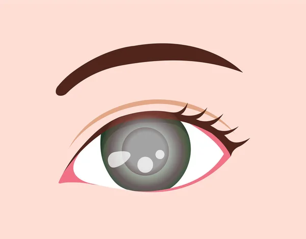 Ojo Enfermedad Vector Ilustración Glaucoma — Archivo Imágenes Vectoriales