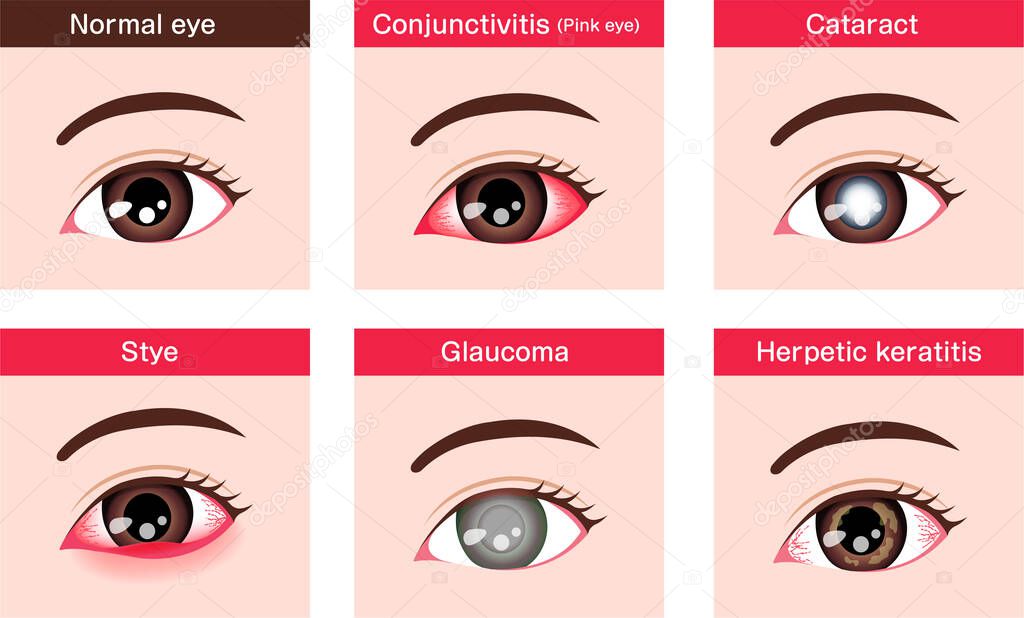 Various eye diseases vector illustration ( female eye )
