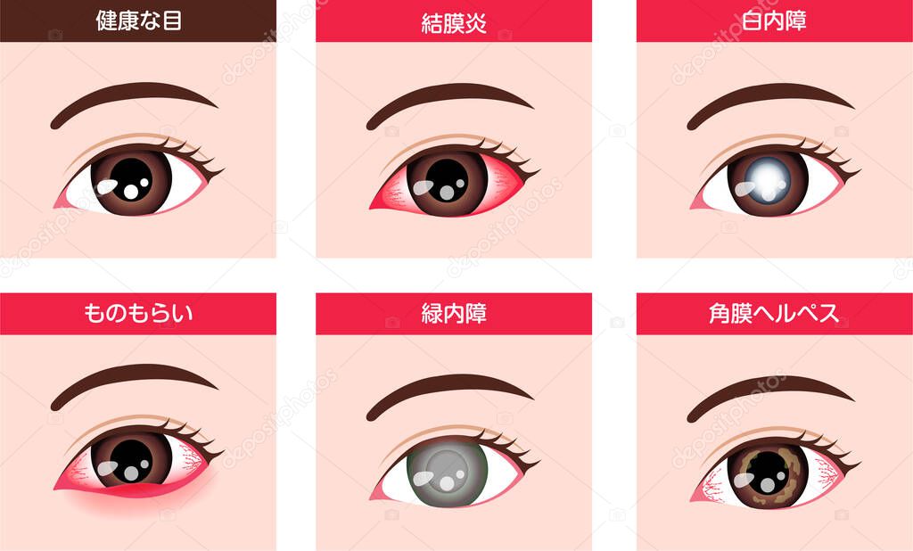 Various eye diseases vector illustration ( female eye )