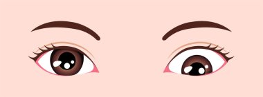 Type of strabismus vector illustration / Hypotropia clipart