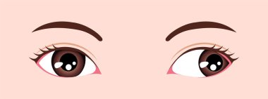Type of strabismus vector illustration / Exotropia clipart