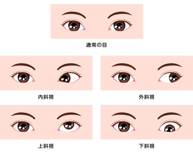 Strabismus vektör çiziminin türleri