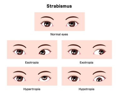 Types of strabismus vector illustration clipart