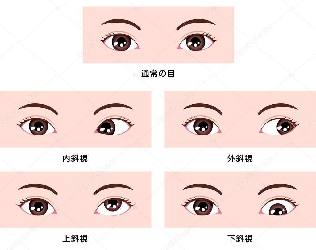 Types of strabismus vector illustration