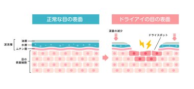 Normal ve kuru göz arasındaki karşılaştırma. Göz yüzeyinin çapraz kesiti. (Japonca)