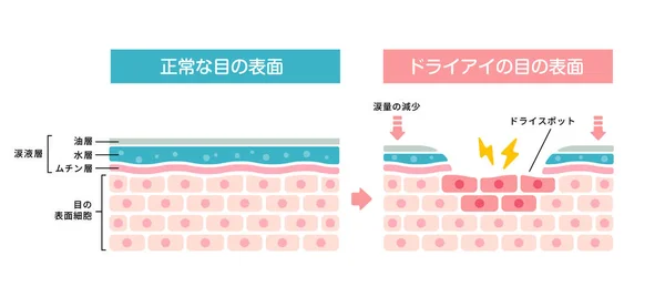 Vergleichsdarstellung Zwischen Normalem Und Trockenem Auge Querschnitt Der Augenoberfläche Japanisch — Stockvektor