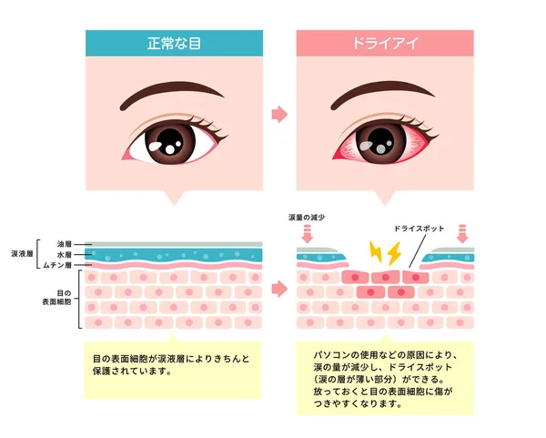 普通の目と乾燥した目の比較図 目の表面の断面 日本語 — ストックベクタ